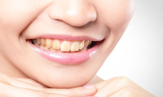 Antes de blanqueamiento dental