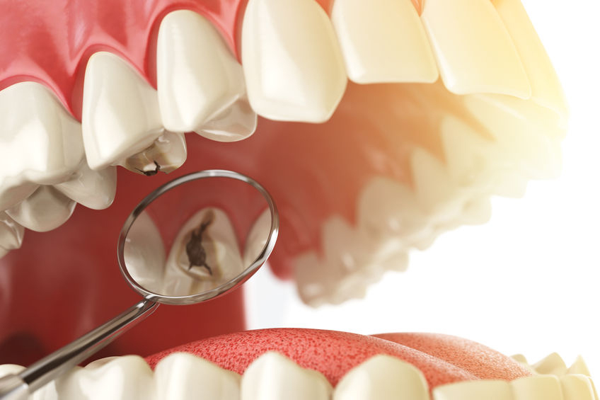La caries